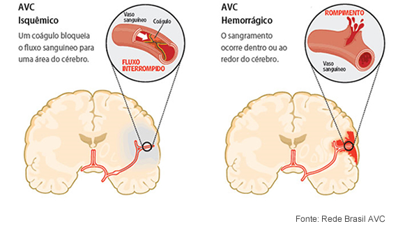 Dia Mundial do AVC